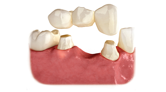 Diagram showing bridge appearing as three white teeth, sitting above two points in the gumline where it will attach