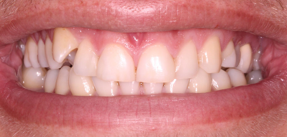 Stained, misaligned teeth before treatment 