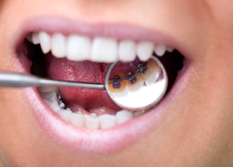 Dentist using mirror tool to look at lingual braces