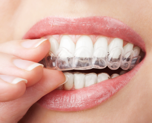 Fingers reach between parted lips to remove clear aligners from teeth