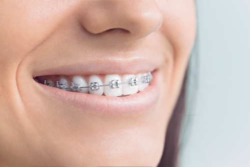 smiling lips showing teeth below with silver fixed braces on top arch