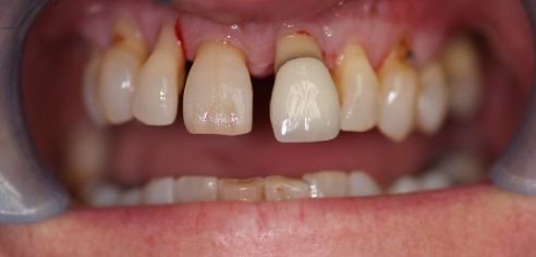 Gappy, unhealthy, protruding teeth before smile in a day treatment at Dental Confidence, part of Bupa