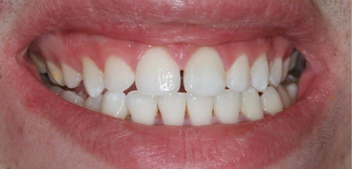 After internal teeth whitening: Bright, white smile