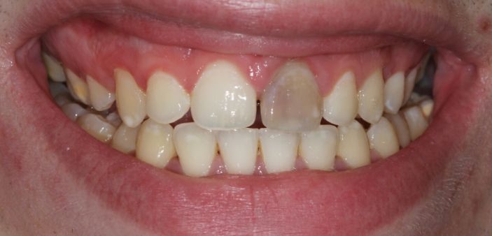 Before internal whitening: Blackened, grey front tooth after root canal