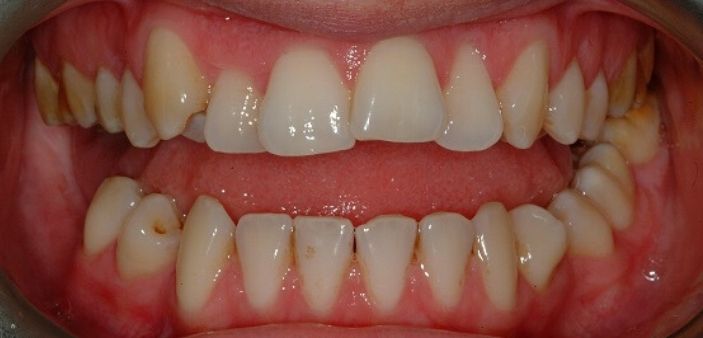 Before treatment: Stained, crooked teeth