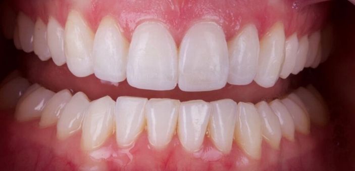 After Invisalign and whitening treatment: Full, straight, white smile