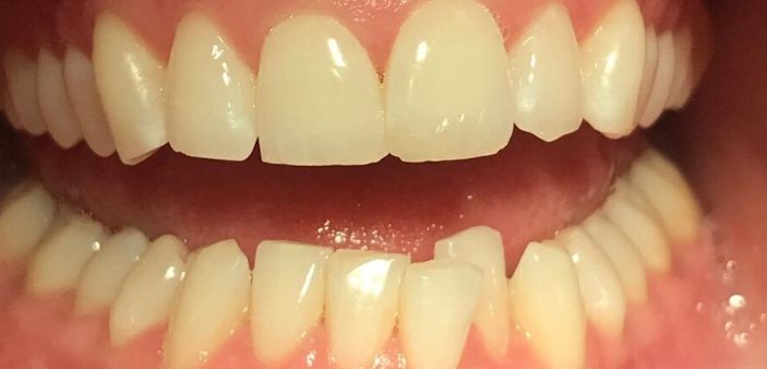 Before Invisalign and whitening treatment: crooked, stained teeth