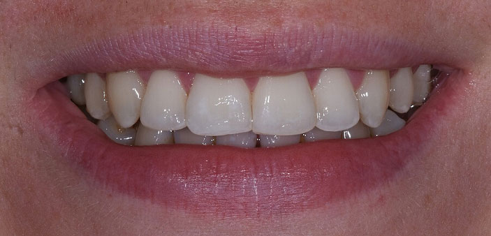 After treatment: straight, white smile following whitening and orthodontics