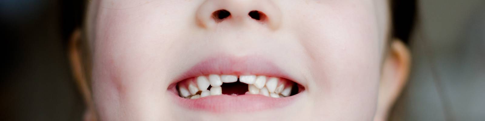 Child with some missing teeth at the front