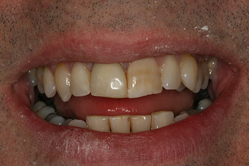 After image shows restored tooth with a dental implant at The Raglan Suite, Harrogate.