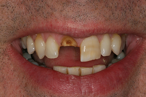 Before image shows smile with broken front tooth before treatment. 